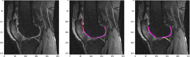 Figure 4 for Knee Cartilage Segmentation Using Diffusion-Weighted MRI