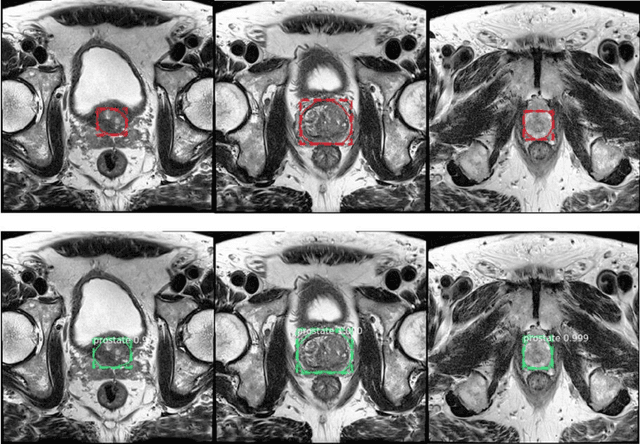 Figure 3 for Segmentation of the Prostatic Gland and the Intraprostatic Lesions on Multiparametic MRI Using Mask-RCNN