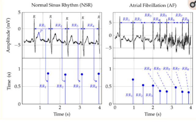 Figure 1 for Analysis of ECG data to detect Atrial Fibrillation