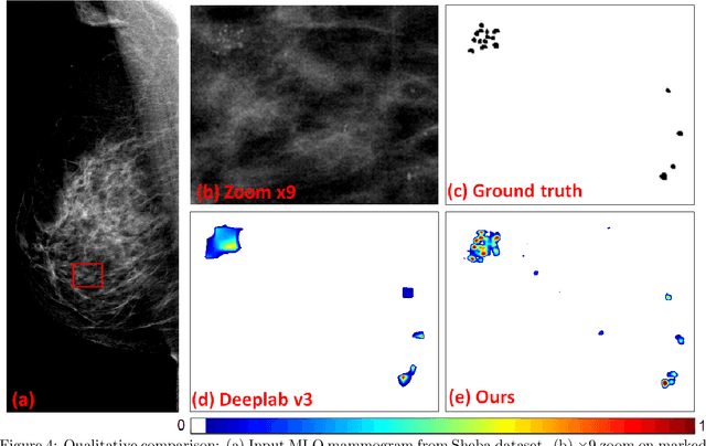 Figure 4 for Segmenting Microcalcifications in Mammograms and its Applications