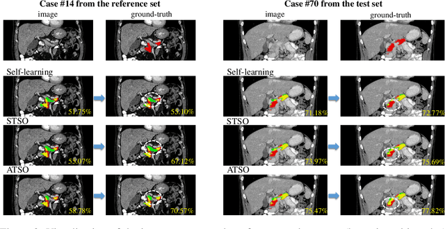 Figure 4 for ATSO: Asynchronous Teacher-Student Optimizationfor Semi-Supervised Medical Image Segmentation