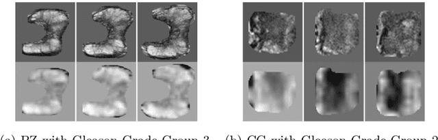 Figure 4 for Prostate Cancer Malignancy Detection and localization from mpMRI using auto-Deep Learning: One Step Closer to Clinical Utilization