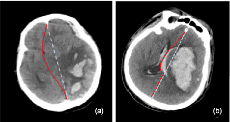 Figure 1 for Segmentation-based Method combined with Dynamic Programming for Brain Midline Delineation