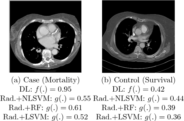 Figure 3 for Automated 5-year Mortality Prediction using Deep Learning and Radiomics Features from Chest Computed Tomography