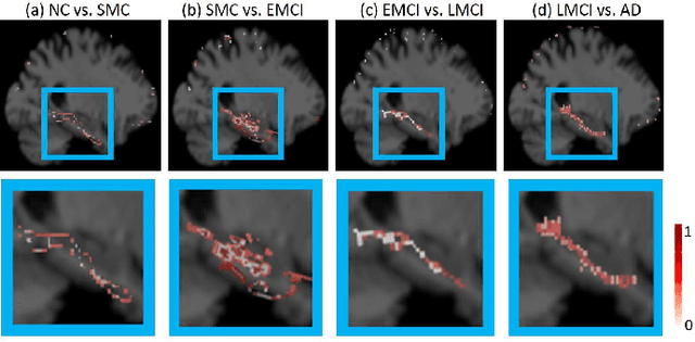 Figure 2 for Morphological feature visualization of Alzheimer's disease via Multidirectional Perception GAN