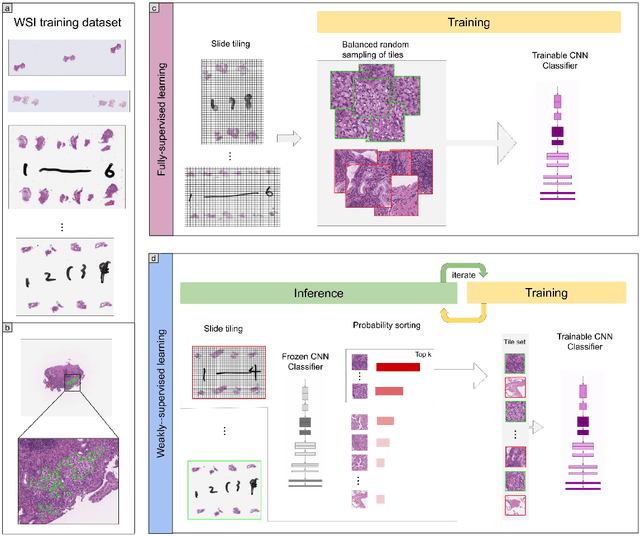 Figure 1 for Deep learning models for gastric signet ring cell carcinoma classification in whole slide images