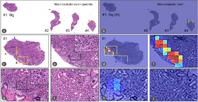 Figure 3 for Deep learning models for gastric signet ring cell carcinoma classification in whole slide images