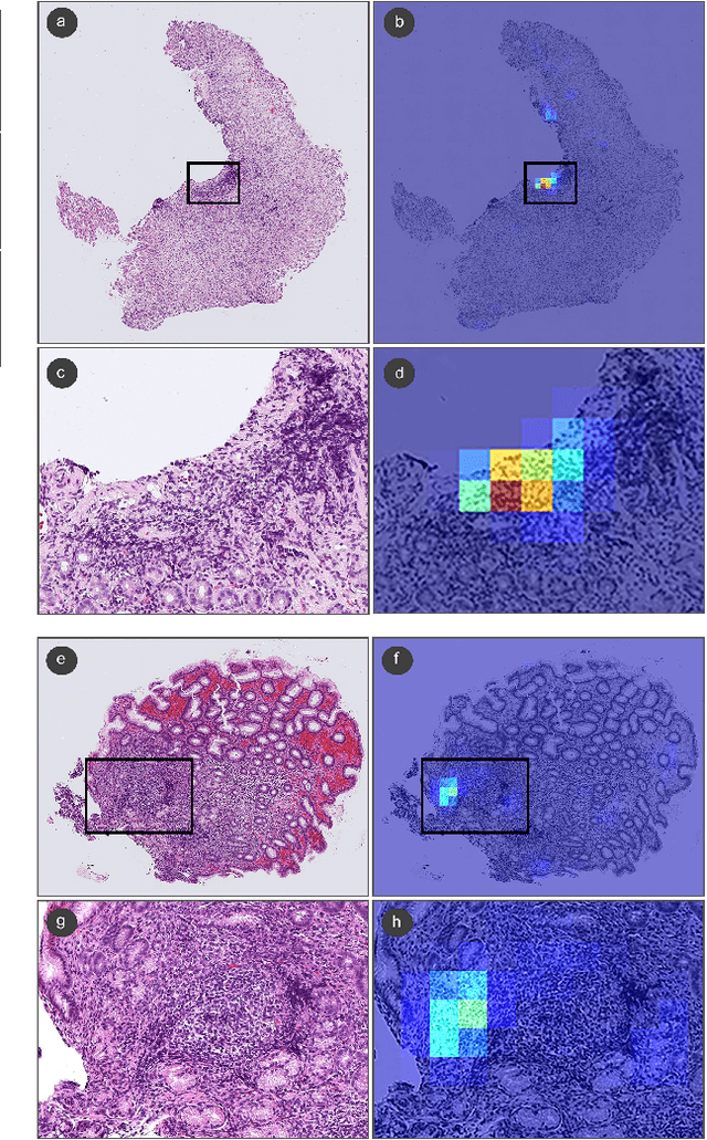 Figure 4 for Deep learning models for gastric signet ring cell carcinoma classification in whole slide images