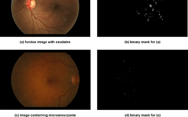 Figure 1 for DRDr: Automatic Masking of Exudates and Microaneurysms Caused By Diabetic Retinopathy Using Mask R-CNN and Transfer Learning