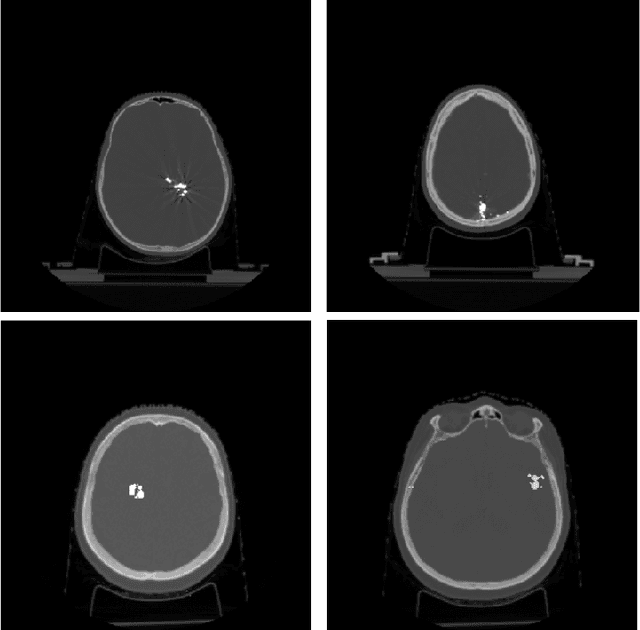 Figure 1 for Multi-domain CT metal artifacts reduction using partial convolution based inpainting