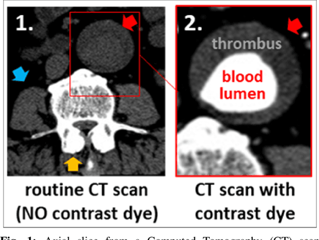 Figure 1 for A Deep learning Approach to Generate Contrast-Enhanced Computerised Tomography Angiography without the Use of Intravenous Contrast Agents
