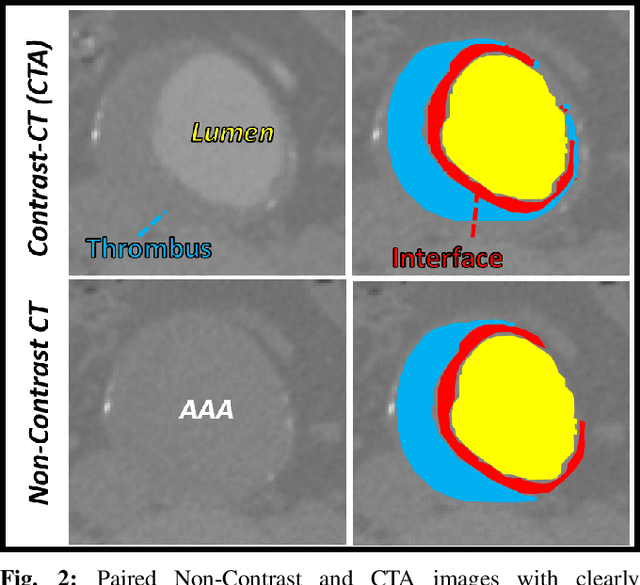 Figure 2 for A Deep learning Approach to Generate Contrast-Enhanced Computerised Tomography Angiography without the Use of Intravenous Contrast Agents