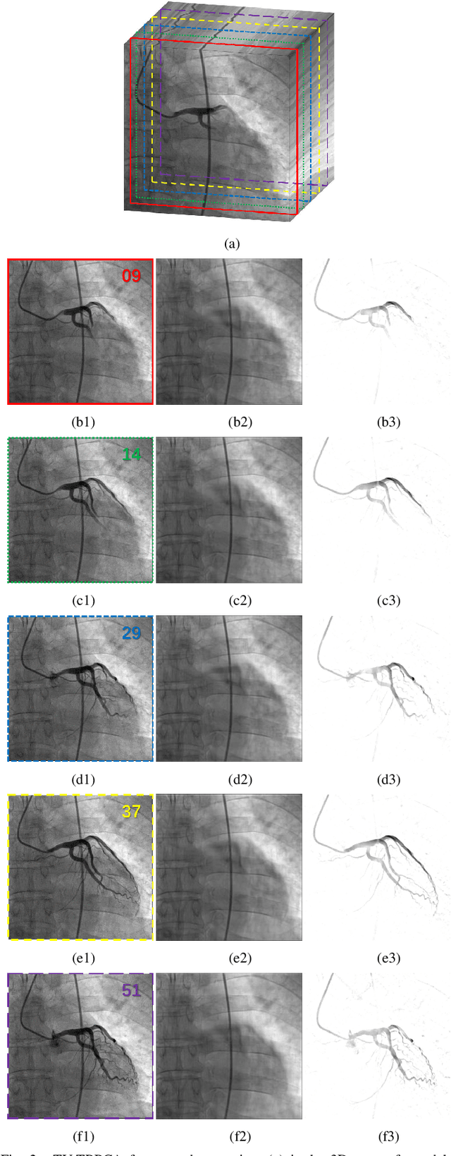 Figure 2 for Robust Implementation of Foreground Extraction and Vessel Segmentation for X-ray Coronary Angiography Image Sequence