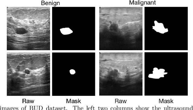 Figure 4 for Joint localization and classification of breast tumors on ultrasound images using a novel auxiliary attention-based framework