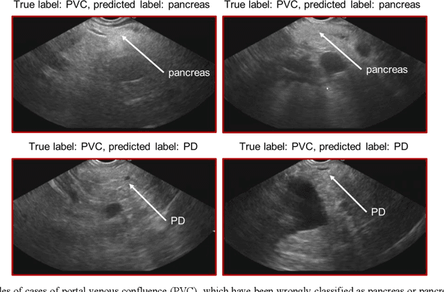 Figure 4 for Voice-assisted Image Labelling for Endoscopic Ultrasound Classification using Neural Networks