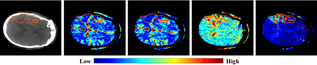 Figure 1 for Ischemic Stroke Lesion Segmentation in CT Perfusion Scans using Pyramid Pooling and Focal Loss