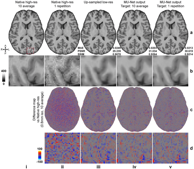 Figure 4 for SRNR: Training neural networks for Super-Resolution MRI using Noisy high-resolution Reference data