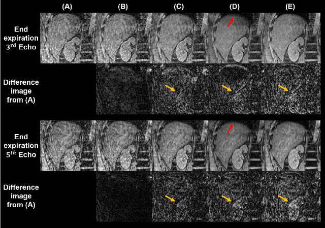 Figure 2 for A Novel Low-Rank Tensor Method for Undersampling Artifact Removal in Respiratory Motion-Resolved Multi-Echo 3D Cones MRI