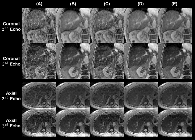 Figure 3 for A Novel Low-Rank Tensor Method for Undersampling Artifact Removal in Respiratory Motion-Resolved Multi-Echo 3D Cones MRI