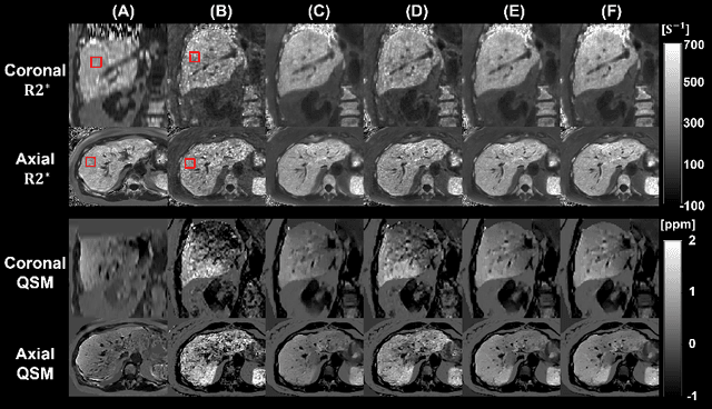 Figure 4 for A Novel Low-Rank Tensor Method for Undersampling Artifact Removal in Respiratory Motion-Resolved Multi-Echo 3D Cones MRI
