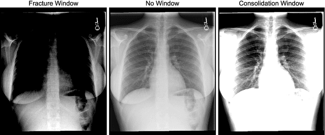 Figure 1 for WindowNet: Learnable Windows for Chest X-ray Classification