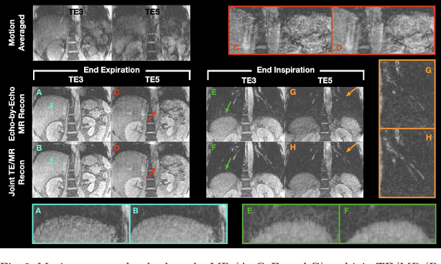 Figure 3 for Joint Multi-Echo/Respiratory Motion-Resolved Compressed Sensing Reconstruction of Free-Breathing Non-Cartesian Abdominal MRI