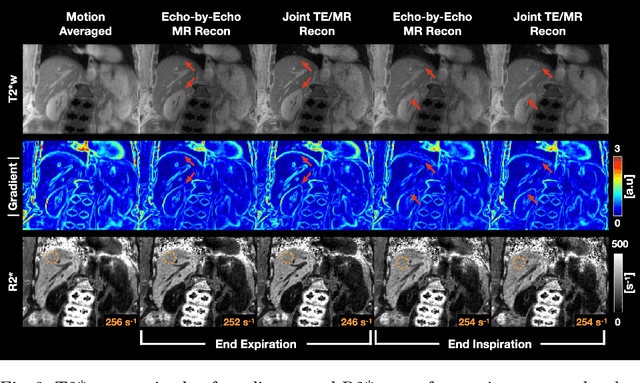 Figure 4 for Joint Multi-Echo/Respiratory Motion-Resolved Compressed Sensing Reconstruction of Free-Breathing Non-Cartesian Abdominal MRI