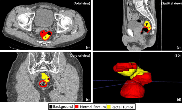 Figure 1 for CARE: A Large Scale CT Image Dataset and Clinical Applicable Benchmark Model for Rectal Cancer Segmentation