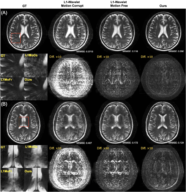 Figure 3 for Accelerated Motion Correction for MRI using Score-Based Generative Models