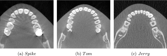 Figure 1 for Motion Artifacts Detection in Short-scan Dental CBCT Reconstructions