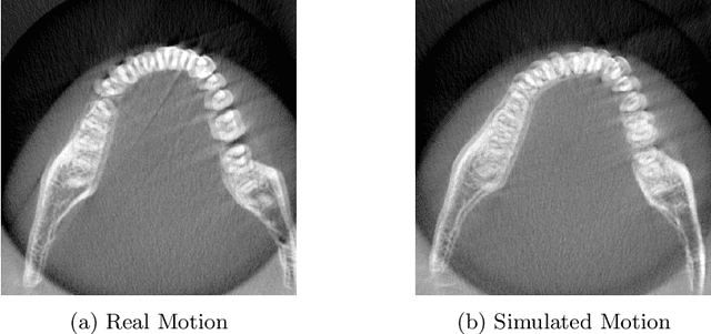 Figure 3 for Motion Artifacts Detection in Short-scan Dental CBCT Reconstructions