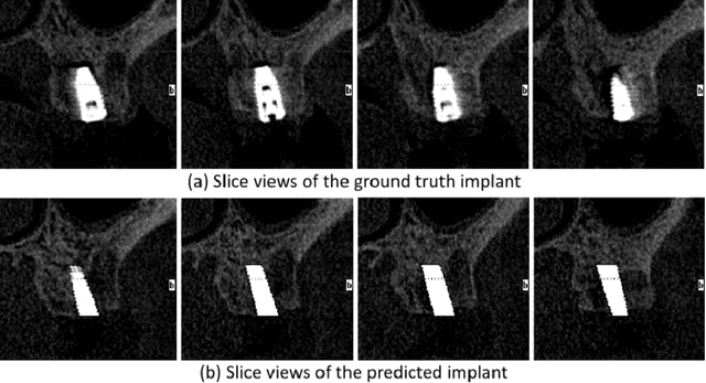 Figure 3 for ImplantFormer: Vision Transformer based Implant Position Regression Using Dental CBCT Data