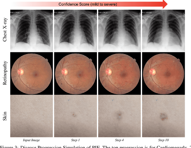 Figure 4 for PIE: Simulating Disease Progression via Progressive Image Editing