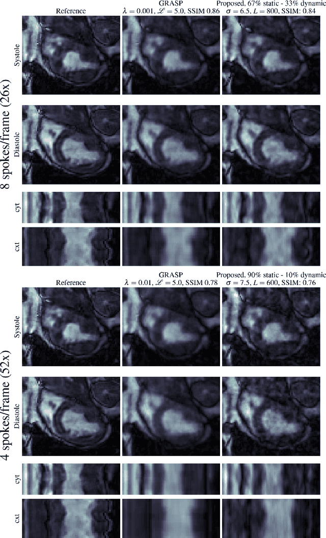 Figure 4 for Unsupervised reconstruction of accelerated cardiac cine MRI using Neural Fields
