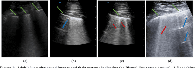 Figure 1 for Automatic Feature Detection in Lung Ultrasound Images using Wavelet and Radon Transforms