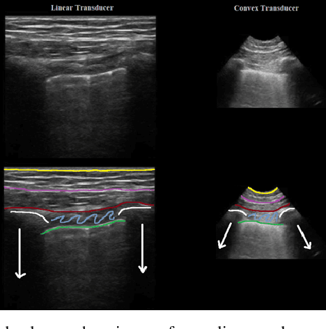 Figure 4 for Automatic Feature Detection in Lung Ultrasound Images using Wavelet and Radon Transforms