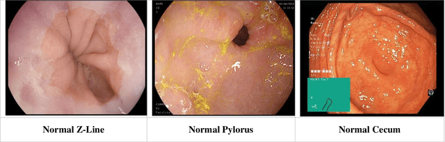 Figure 1 for Gastrointestinal Mucosal Problems Classification with Deep Learning