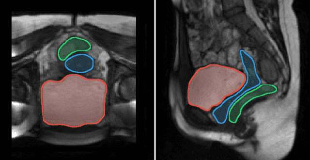 Figure 1 for Three-dimensional reconstruction and characterization of bladder deformations