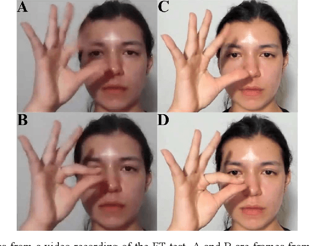 Figure 2 for Video-Based Hand Pose Estimation for Remote Assessment of Bradykinesia in Parkinson's Disease