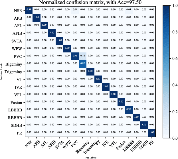 Figure 3 for Arrhythmia Classifier Based on Ultra-Lightweight Binary Neural Network