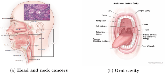 Figure 1 for Diagnosis and Prognosis of Head and Neck Cancer Patients using Artificial Intelligence
