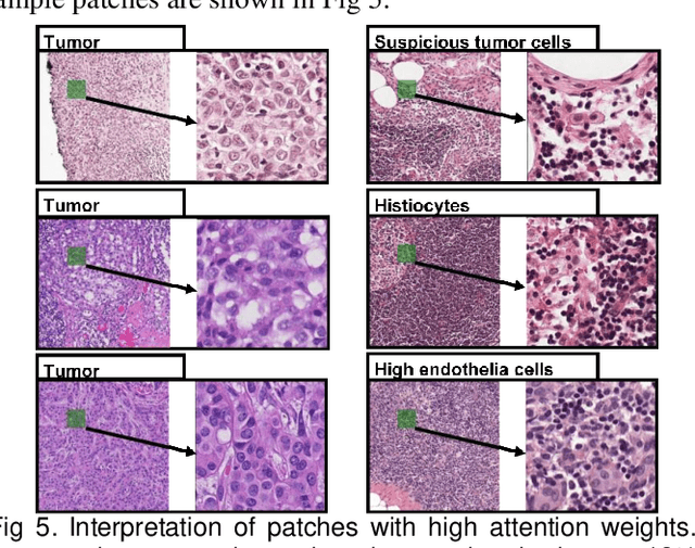 Figure 3 for Cross-attention-based saliency inference for predicting cancer metastasis on whole slide images