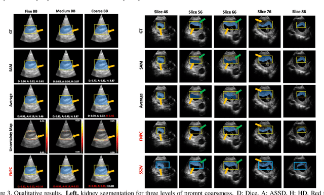 Figure 4 for False Negative/Positive Control for SAM on Noisy Medical Images