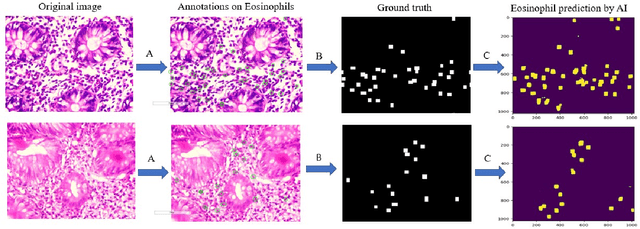 Figure 1 for Artificial Intelligence-based Eosinophil Counting in Gastrointestinal Biopsies