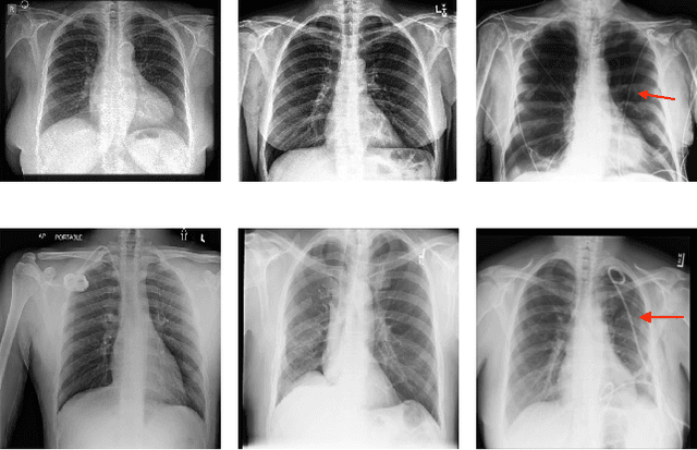 Figure 1 for Detecting Shortcuts in Medical Images -- A Case Study in Chest X-rays
