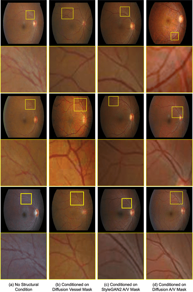 Figure 3 for Generation of Structurally Realistic Retinal Fundus Images with Diffusion Models