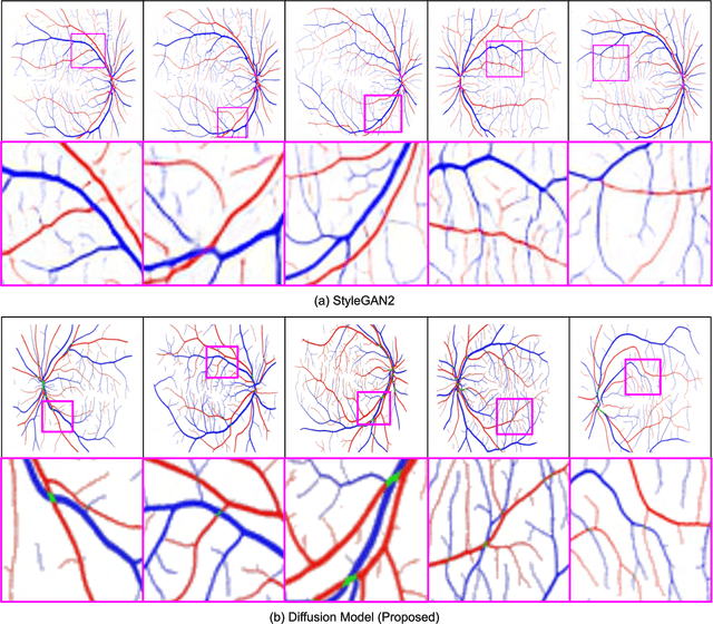 Figure 4 for Generation of Structurally Realistic Retinal Fundus Images with Diffusion Models