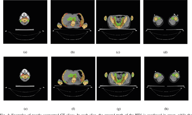 Figure 4 for Segmentation of Planning Target Volume in CT Series for Total Marrow Irradiation Using U-Net