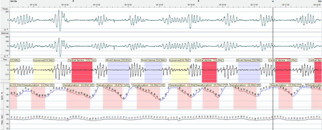 Figure 1 for AIOSA: An approach to the automatic identification of obstructive sleep apnea events based on deep learning