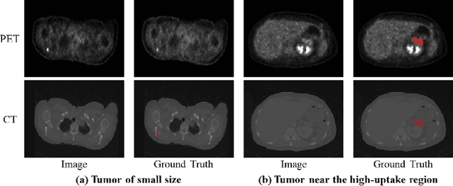 Figure 1 for A Localization-to-Segmentation Framework for Automatic Tumor Segmentation in Whole-Body PET/CT Images